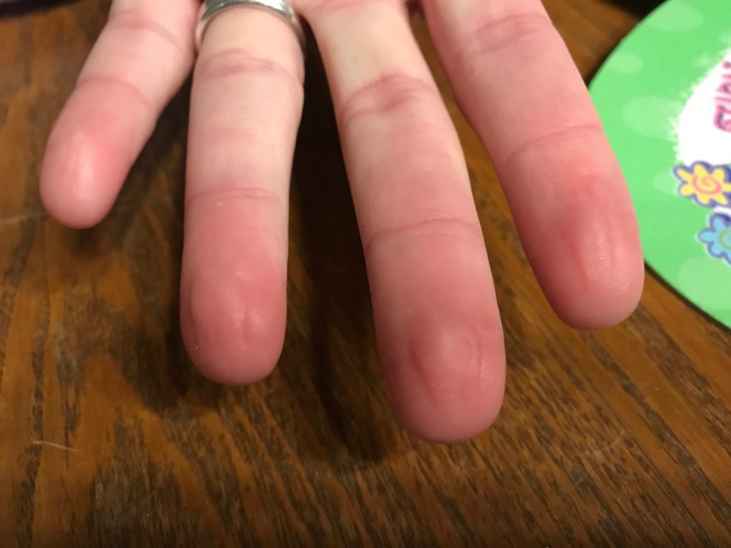 Fingertips looking pinched